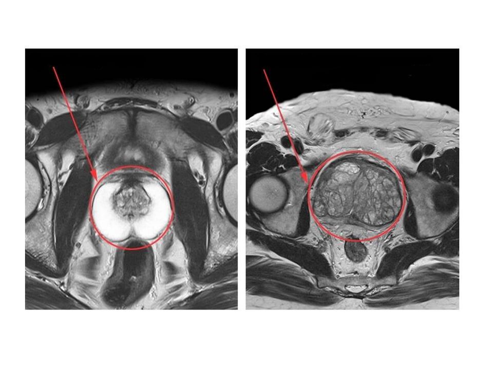 Comparación dunha próstata sa (esquerda) e unha inflamada (dereita) en imaxes de resonancia magnética